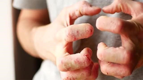 Da nổi mẩn ngứa gãi xoành xoạch - Ơn trời chỉ nhờ cách này hết ngứa lúc nào không biết! - 2