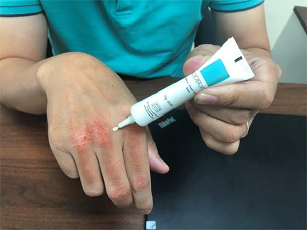 Da nổi mẩn ngứa gãi xoành xoạch - Ơn trời chỉ nhờ cách này hết ngứa lúc nào không biết! - 4