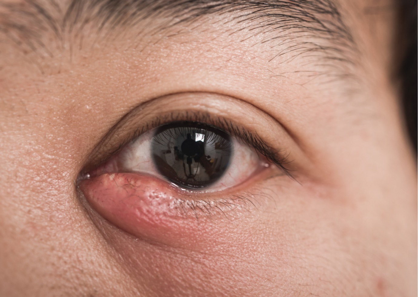 Viêm mí mắt - Nguyên nhân và cách phòng ngừa hiệu quả bạn nên biết - 1