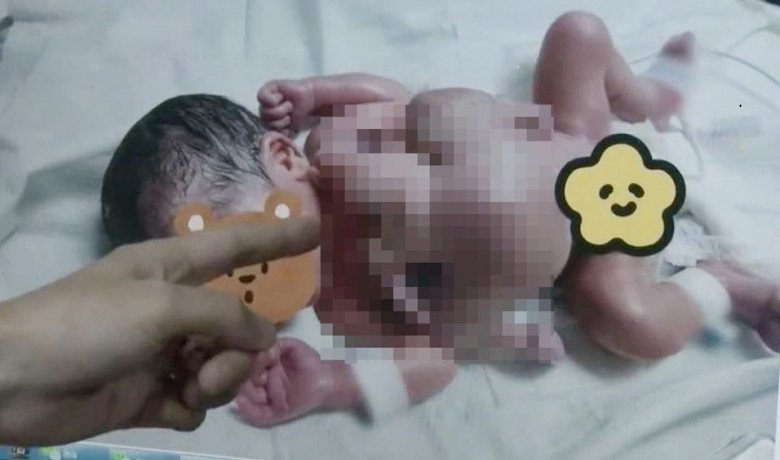Cứu sống bé trai sơ sinh 2,9kg bị bào thai ký sinh đeo bám suốt thai kỳ - 1