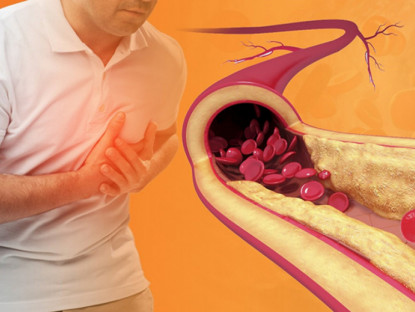 Thông tin doanh nghiệp - Sản phẩm MeQuib VAS đột phá hỗ trợ giảm nguy cơ xơ vữa động mạch
