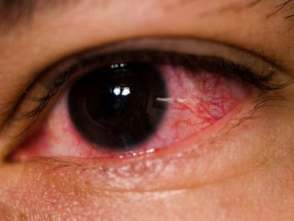 Xã hội - Bộ Y tế hướng dẫn cách xử trí khi bị đau mắt đỏ