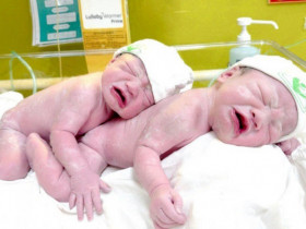 Cặp song sinh siêu nghịch: Một bé có dây rốn thắt nút, một bé bị 3 vòng rau quấn cổ