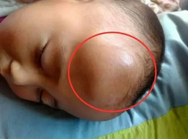 Bé 1 tuổi bị ngã đập đầu xuống đất, cách xử lý thông minh của người mẹ được bác sĩ khen ngợi - 1