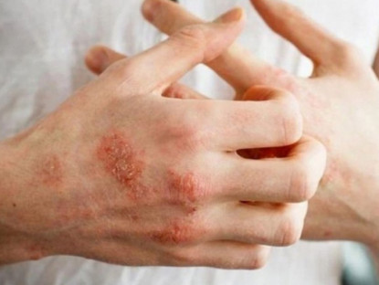 Thông tin doanh nghiệp - Giải mã bệnh chàm: Nguyên nhân, triệu chứng và phương pháp điều trị hiệu quả