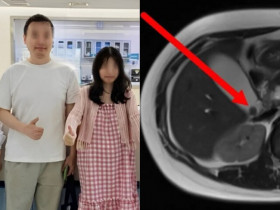 Cơ thể bà bầu đột nhiên chuyển vàng phải đi cấp cứu, bác sĩ phát hiện 2 “vật thể lạ” trong ổ bụng, phải phẫu thuật để giữ mạng sống