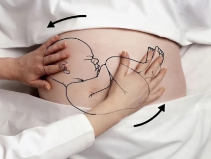 Gia đình - Từ chuyện một hoa hậu Việt nhờ bà đỡ xoay ngôi thai và góc nhìn y khoa: Hiểu đúng vì sự an toàn của mẹ và bé