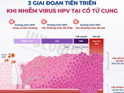 Thông tin doanh nghiệp - Nhiễm HPV không có nghĩa chắc chắn sẽ ung thư