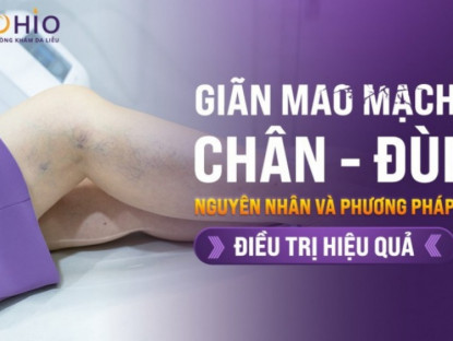 Thông tin doanh nghiệp - Giãn mao mạch chân đùi: Nguyên nhân và cách điều trị