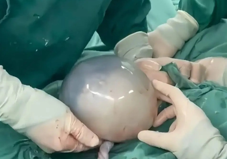Lấy vợ là bạn thân đại học, chồng nằng nặc đòi vào phòng mổ đẻ và cái kết hốt hoảng khi lần đầu nhìn thấy em bé - 3