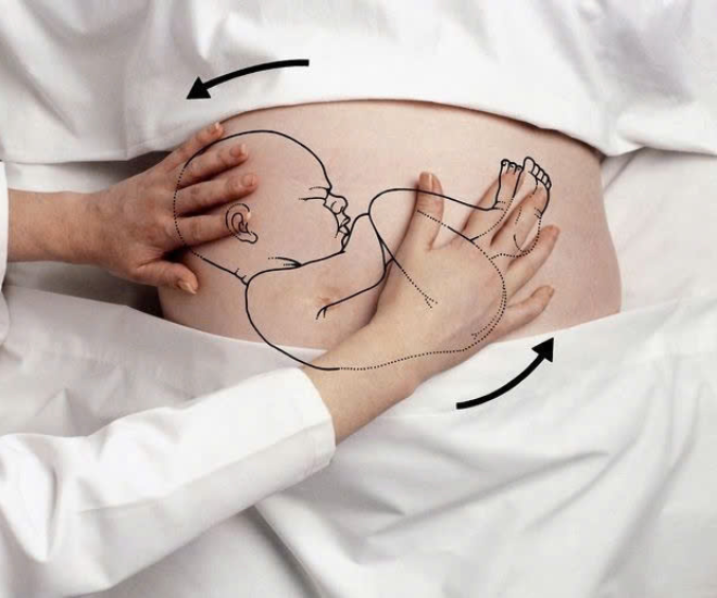 Từ chuyện một hoa hậu Việt nhờ bà đỡ xoay ngôi thai và góc nhìn y khoa: Hiểu đúng vì sự an toàn của mẹ và bé - 1