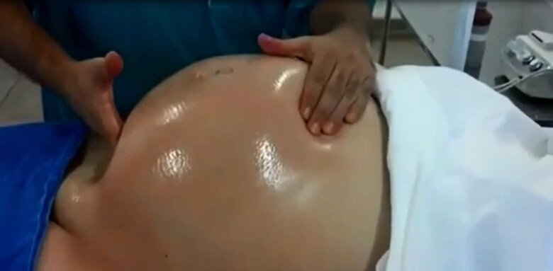 Từ chuyện một hoa hậu Việt nhờ bà đỡ xoay ngôi thai và góc nhìn y khoa: Hiểu đúng vì sự an toàn của mẹ và bé - 2