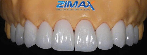 Kiến tạo nụ cười chuẩn tự nhiên và an toàn sinh học cùng răng toàn sứ Zimax - 4