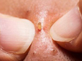 Đàn ông con trai bị mụn: Chấm dung dịch này mỗi tối là sạch, không cần đi Spa với bôi kem như con gái