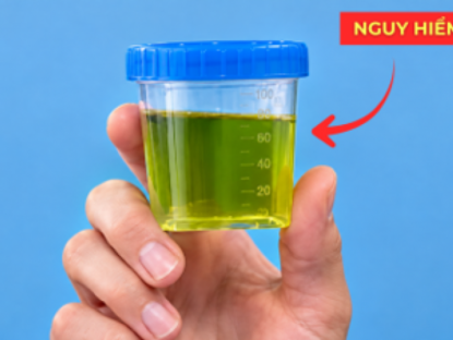 Thông tin doanh nghiệp - Nước tiểu buổi sáng có màu này, coi chừng cơ thể đang phát tín hiệu “cầu cứu”!