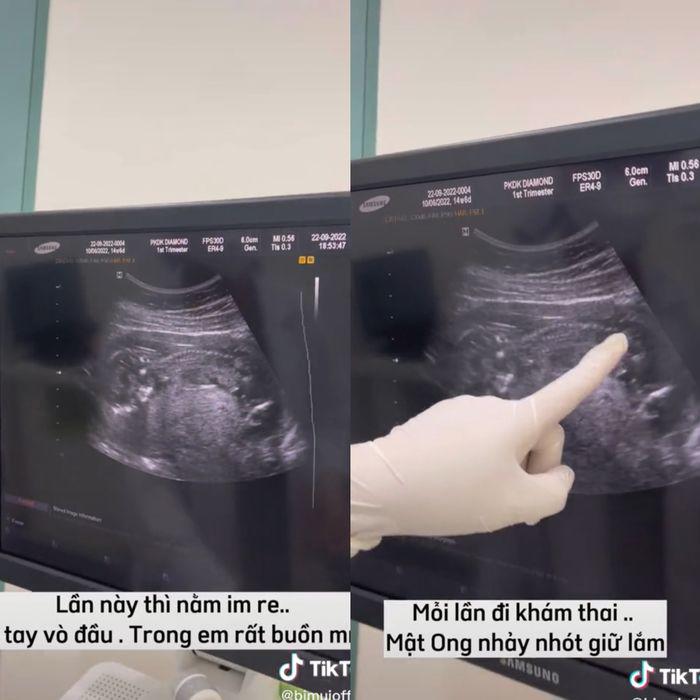 Múi Xù tăng gần 10kg khi mang thai nhưng em bé vẫn thiếu cân: Mẹ bầu ăn gì để vào con không vào mẹ? - 5
