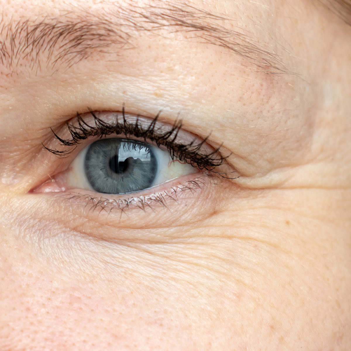 Trẻ hơn 10 tuổi nhờ hết nhăn mắt: Từ kem dưỡng tới bơm chất làm đầy - 1