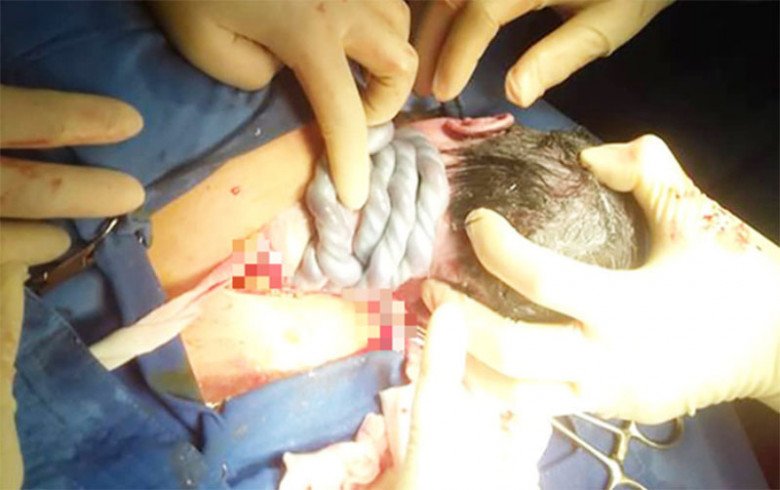 5 đồn thổi về dây rốn quấn cổ thai nhi, mẹ bầu phải biết để đi đẻ an toàn - 1