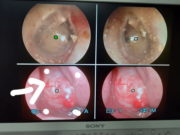 Con trai nghẹt mũi, chảy máu 3 tháng mới cho đi khám, kết quả ngoài sự tưởng tượng của gia đình - 1