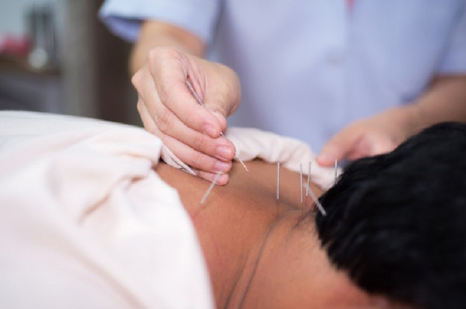 Châm cứu bấm huyệt để giảm đau nhức lưng, đau mỏi vai gáy – Cần biết ngay điều này! - 2