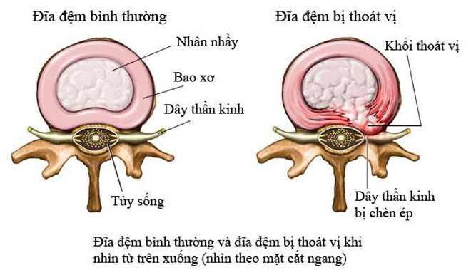 Đứng lên ngồi xuống đau lưng, tê bì chân tay - Chuyên gia cảnh báo thủ phạm đáng sợ! - 2
