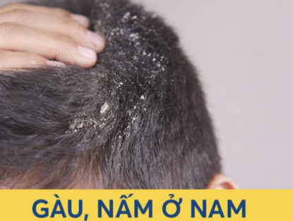 Thông tin doanh nghiệp - Gàu ngứa dai dẳng - &quot;khắc tinh&quot; mùa thu đông của nam giới quay trở lại!