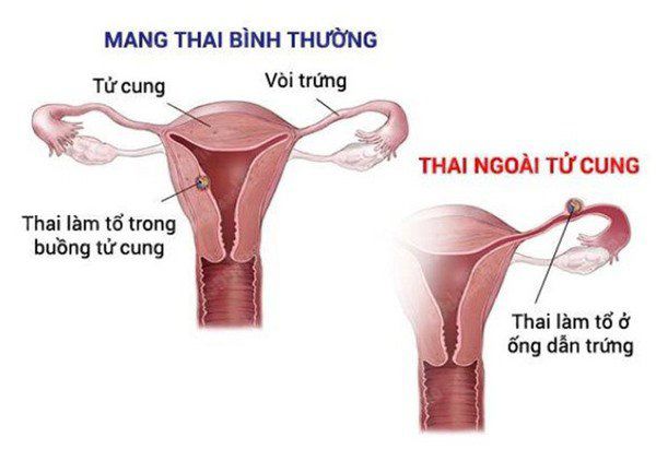 Bà mẹ mang thai ngoài tử cung ở vị trí rất hiểm, kỳ lạ hơn là thai nhi vẫn chào đời an toàn - 2