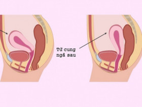 Nếu có tử cung ngả sau, mẹ bầu nên cân nhắc chuyện sinh mổ, vì sao?