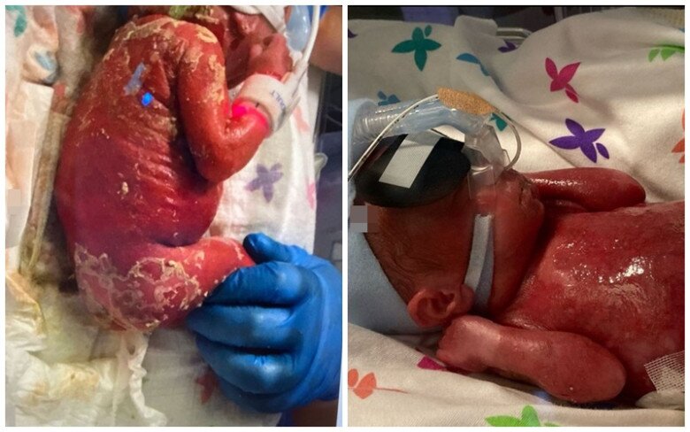 Em bé chào đời khiến bác sĩ bất ngờ với làn da đỏ ửng như bị bỏng - 2