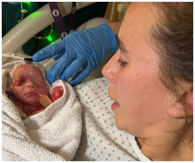 Em bé chào đời khiến bác sĩ bất ngờ với làn da đỏ ửng như bị bỏng - 1