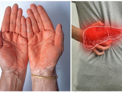 Y tế - Những dấu hiệu ở tay cảnh báo gan đang "kêu cứu"
