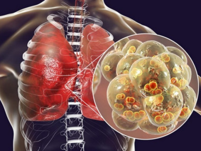 Y tế - 8 dấu hiệu lá phổi đang &quot;kêu cứu&quot;