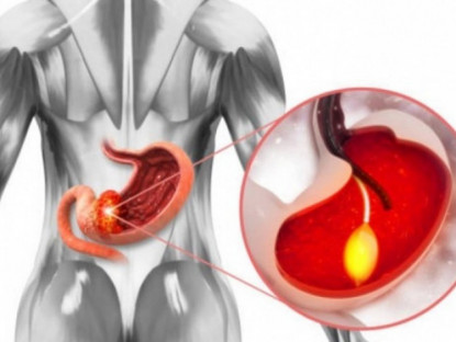 Y tế - Ung thư tuyến tụy là sát thủ thầm lặng, làm thế nào để tránh?