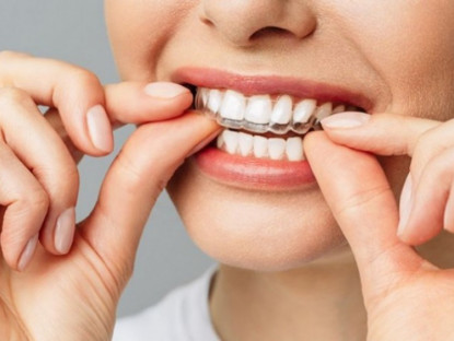 Thông tin doanh nghiệp - Phương pháp niềng răng tháo lắp là gì? Có bao nhiêu loại?