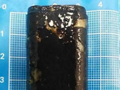 Y tế - Người đàn ông sống với chiếc bật lửa trong bụng suốt 30 năm