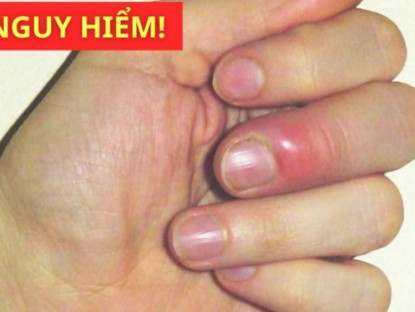 Thông tin doanh nghiệp - Phát hiện phổi “gặp nguy hiểm” nhờ 3 dấu hiệu trên ngón tay mà nhiều người thường bỏ qua!