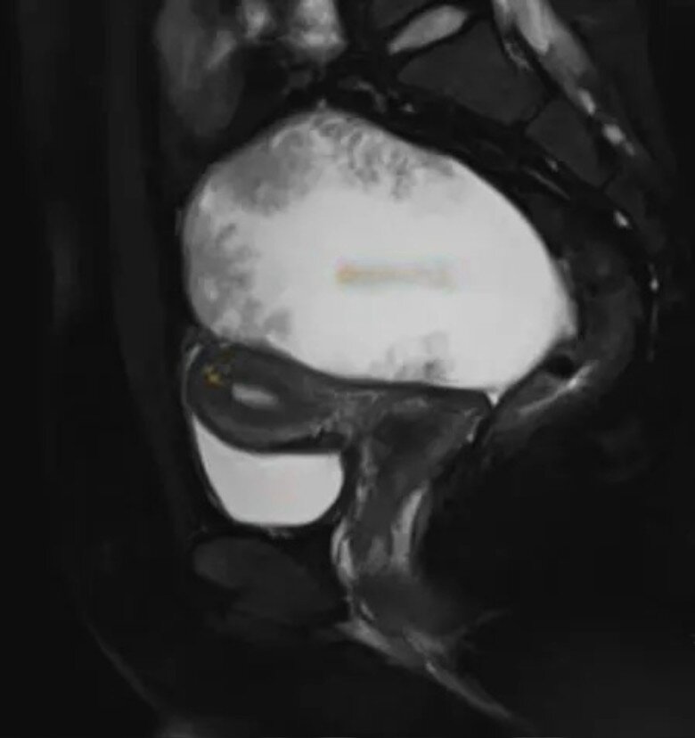 Đau bụng 1 tuần không khỏi, kết quả siêu âm khiến thiếu nữ sụp đổ, nhắc về sai lầm tai hại 2 năm trước - 2