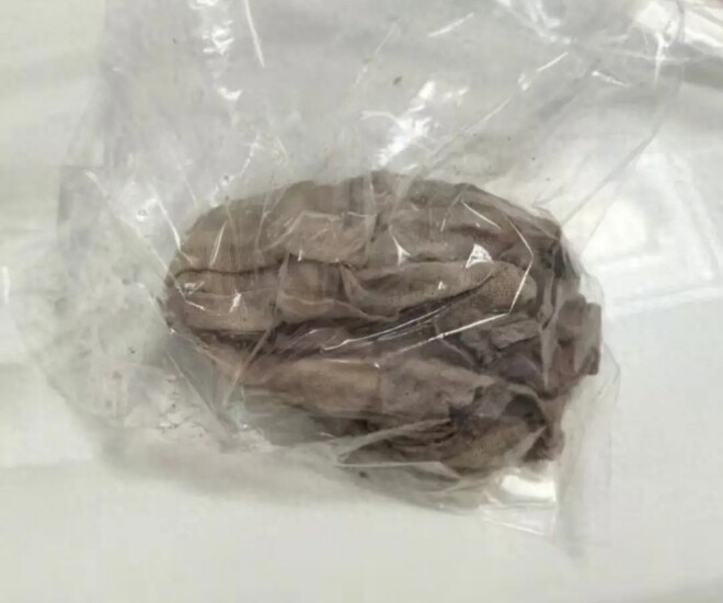 Sản phụ bụng sưng phù sau ca mổ đẻ, bác sĩ lấy ra “vật thể lạ” bị bỏ quên suốt 50 ngày - 1