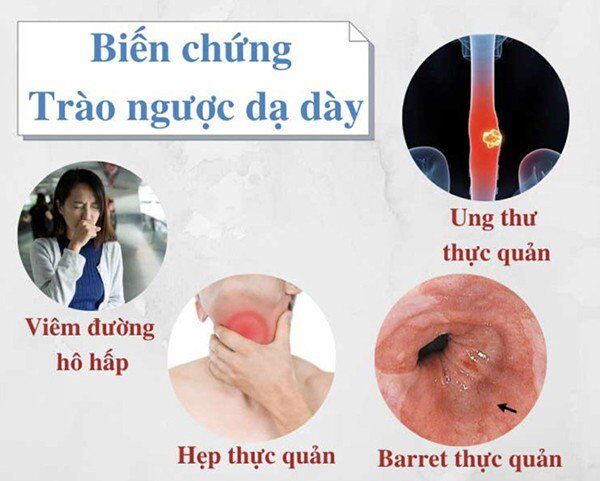 Sai lầm nghiêm trọng nếu nghĩ các biểu hiện của trào ngược dạ dày chỉ là bệnh nhẹ, vì chưa biết điều này - 1