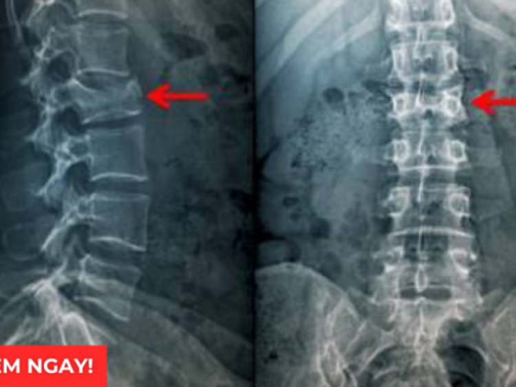 Thông tin doanh nghiệp - 3 tư thế ngủ tốt nhất giúp giảm đau rõ rệt cho người bị thoái hóa cột sống, thoát vị đĩa đệm